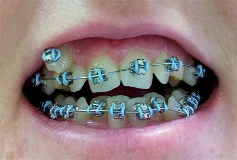 Dental Care Braces For Adults