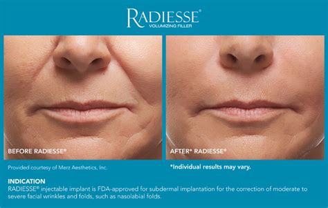 Radiesse In New Jersey Soma Skin And Laser