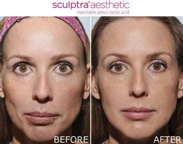 It really helps to drain the. Sculptra | The Better You Clinic & Spa | Cincinnati, Ohio ...