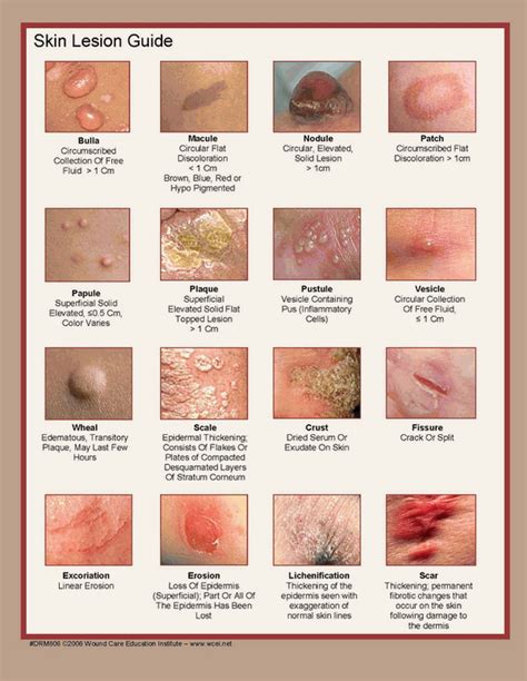 What Are Different Types Of Rashes Headline News 765ure