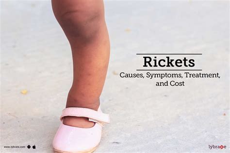 Rickets Causes Symptoms Diagnosis And Treatments
