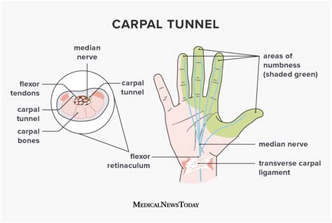 손목굴증후군carpal Tunnel Syndrome 네이버 블로그