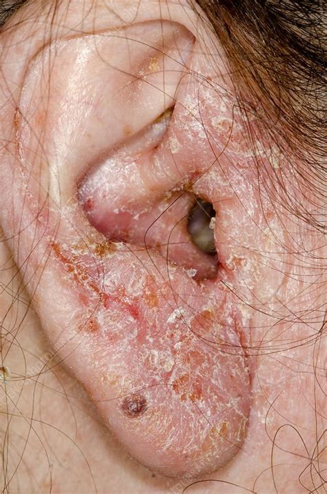 Infected Outer Ear Stock Image C0135805 Science Photo Library
