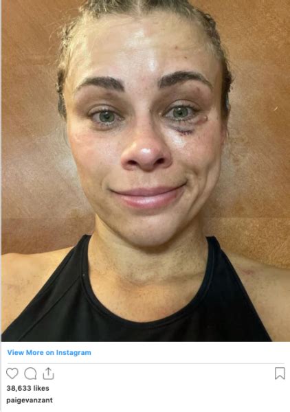 Paige VanZant Shows Off Bruised Face After Brutal Bare Knuckle Debut
