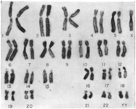 Sex Chromosome Mosaicism Of Type Xyy Xo Nejm