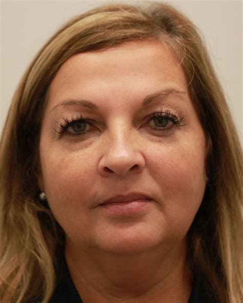 Before Photo Of 52 Year Old Female Treated With Restylane Lyft For