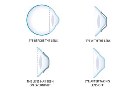 Orthokeratology Contact Lenses Put Nearsightedness To Bed