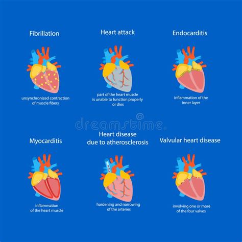 Cartoon Heart Disease Infographic Card Or Poster Vector Stock Vector