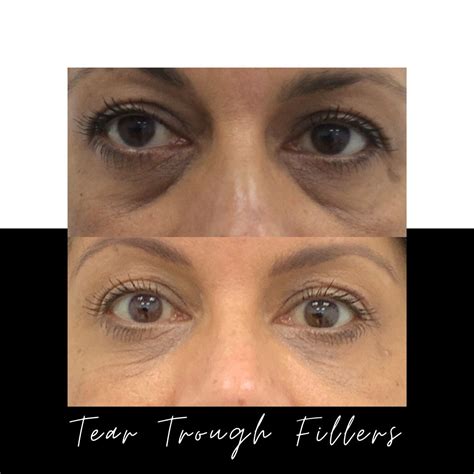 Tear Trough Fillers Before And After Pictures Info Prices Artofit