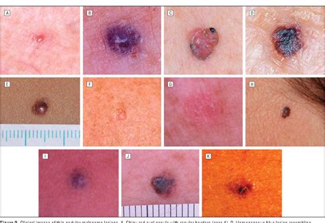 Figure 2 From Historical Clinical And Dermoscopic Characteristics Of
