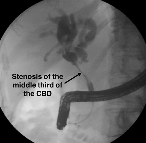 A Rare Cause Of Obstructive Jaundice Diagnosis By Eus And Single