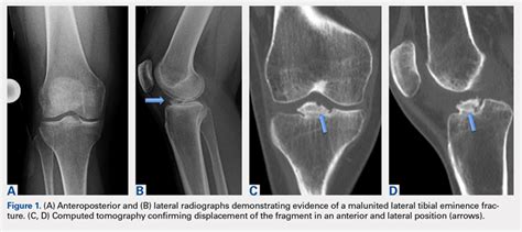 Avulsion Of The Anterior Lateral Meniscal Root Secondary To Tibial