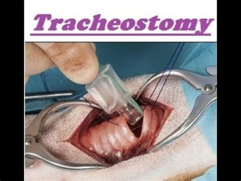 Basic Surgical Procedures Tracheostomy Operative Surgery Youtube