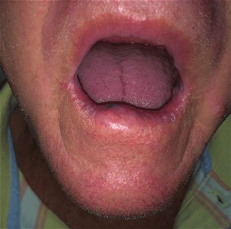 Swollen Lumps On Lips Lipstutorial Org