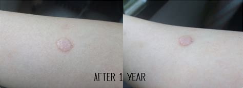 Mole Removal Surgery Part 5 After 1 Year Mystylebite