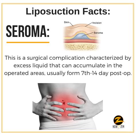 What Is A Seroma