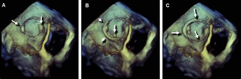 Artifacts In Three Dimensional Transesophageal Echocardiography