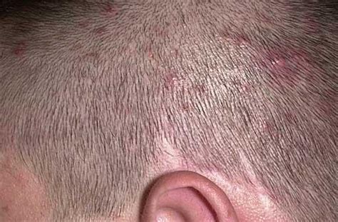 Clogged hair follicles, a condition often called folliculitis, can be unsightly, itchy, and painful. Folliculitis - Hot Tub Rash And Inflammation - Herbal Care ...