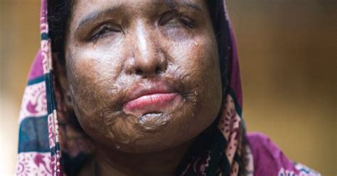 Acid Attack Victims Need Equality To Help Stop Violence Says Campaigner Monira Rahman