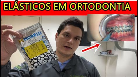 Elástico Ortodôntico 1 8 Para Que Serve