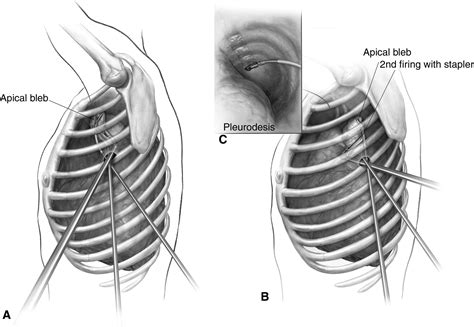 Single Port Video Assisted Thoracic Surgery Uniportal In The Routine