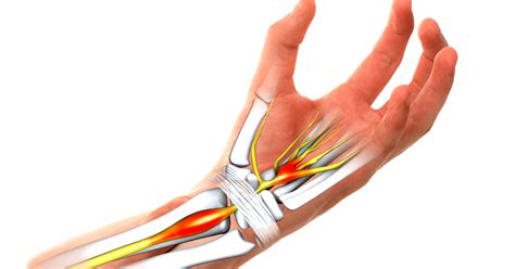 Physiotherapy For Carpal Tunnel Syndrome Learning Physio