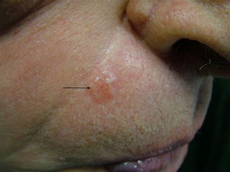 Basal Cell Carcinoma Reddit Basal Cell Carcinoma Removal Treatment