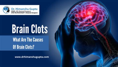 What Are The Causes Of Brain Clots Dr Himanshu Gupta