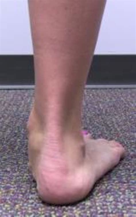 How To Tell If You Have Flat Feet Symptoms Of Flat Feet Orthopedic And Sports Medicine