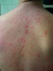 There is no cure, but a vaccine is. The Body In Form: Healing Chicken Pox Naturally
