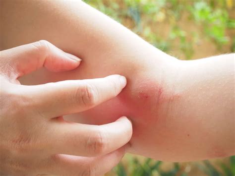 Common Bug Bites And What To Do About Them Arlington Dermatology