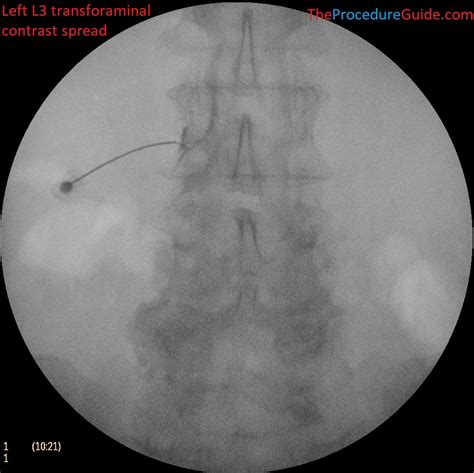 Fluoroscopic Guided Thoraciclumbar Transforaminal Epidural Steroid
