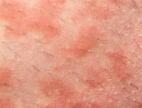 Lamictal Rash