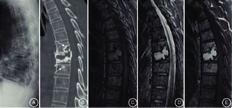 Lateral Spine Radiograph Demonstrated Osteolytic Destruction Of T7 And