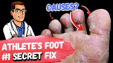 Best Athletes Foot Fungus Treatments Home Remedies 3 Big Secrets
