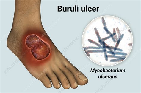 Buruli Ulcer And Mycobacterium Ulcerans Illustration Stock Image F0375207 Science Photo