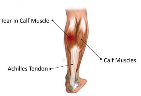 Calf Muscle Pain Cause And Treatment With Exercises For Relief