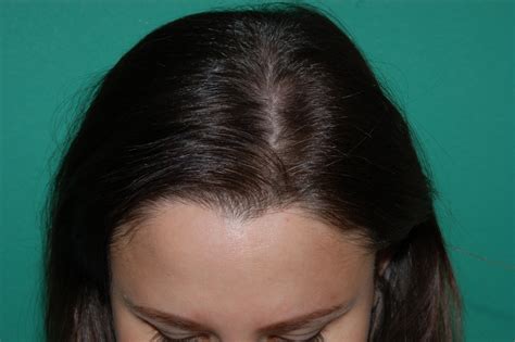 Hair Loss Treatment For Women Chicago Il Chicago Hair Institute