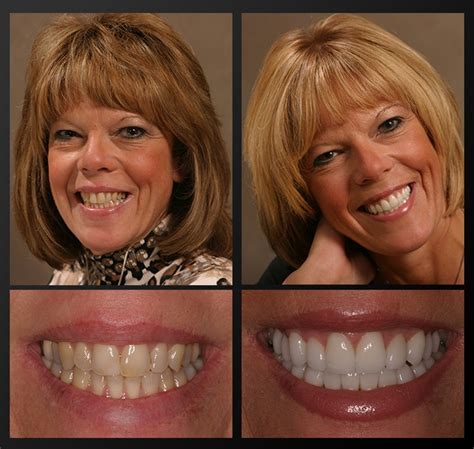 How long does it take to fill a surface cavity. Tooth Colored Fillings Rochester, MI | Drs. Haddad and Doolin
