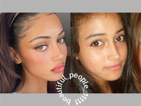 Cindy Kimberly Before After Rhinoplasty Nose Jobs Eye Lift Surgery Face Plastic Surgery