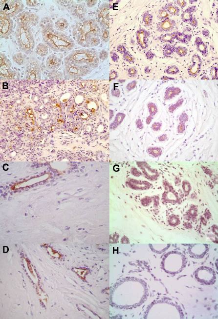 Photomicrographs Of Immunoperoxidase Staining Of Benign Breast Diseases