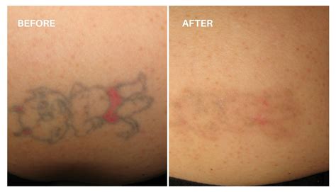 Laser Tattoo Removal In Salt Lake City At Haus Of Aesthetics