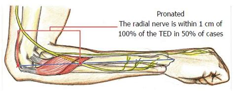 Posterior Interosseous Nerve Localization Within The Proximal Forearm