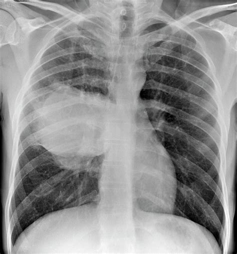 Lung Cancer Photograph By Du Cane Medical Imaging Ltd Pixels