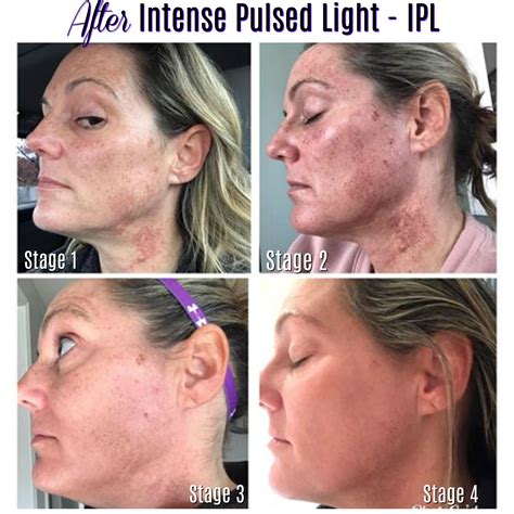 Skin Changes After Intense Pulsed Light IPL Charmed Medispa