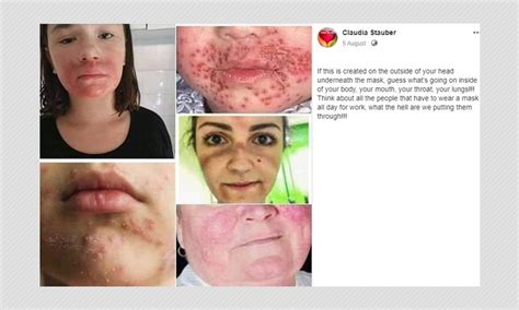 Photos Of Skin Conditions Shared As Effects Of Wearing Face Masks Boom