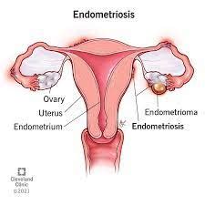 All You Need To Know About Endometriosis