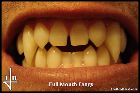 Full Mouth Teeth By Dnash