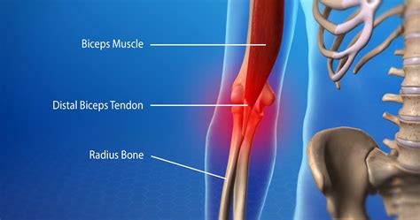 Biceps Tendinitis Bút Chì Xanh