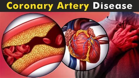 Coronary Artery Disease Cad Causes Symptoms Treatment And Diagnosis